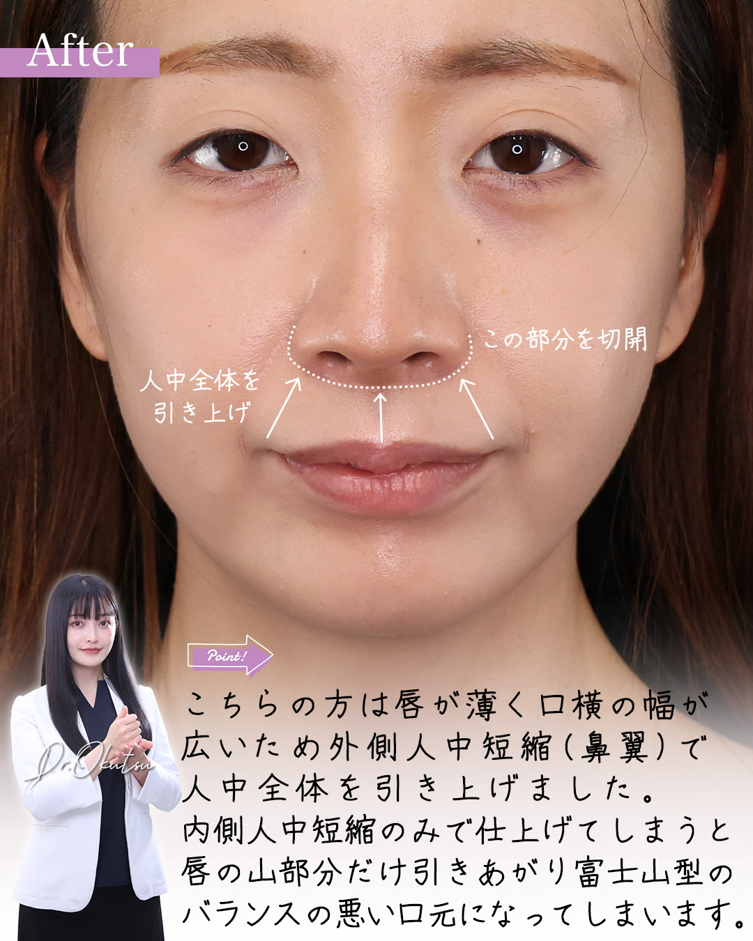 人中短縮術(リップリフト)・外側人中短縮術/ヒアルロン酸注射：その他の症例写真 施術前後 