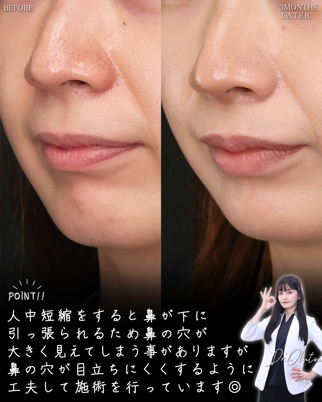 人中短縮術(リップリフト)・外側人中短縮術/ヒアルロン酸注射：その他の症例写真 施術前後 