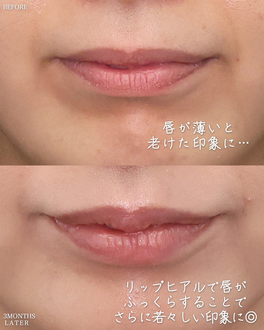 人中短縮術(リップリフト)・外側人中短縮術/ヒアルロン酸注射：その他の症例写真 施術前後 
