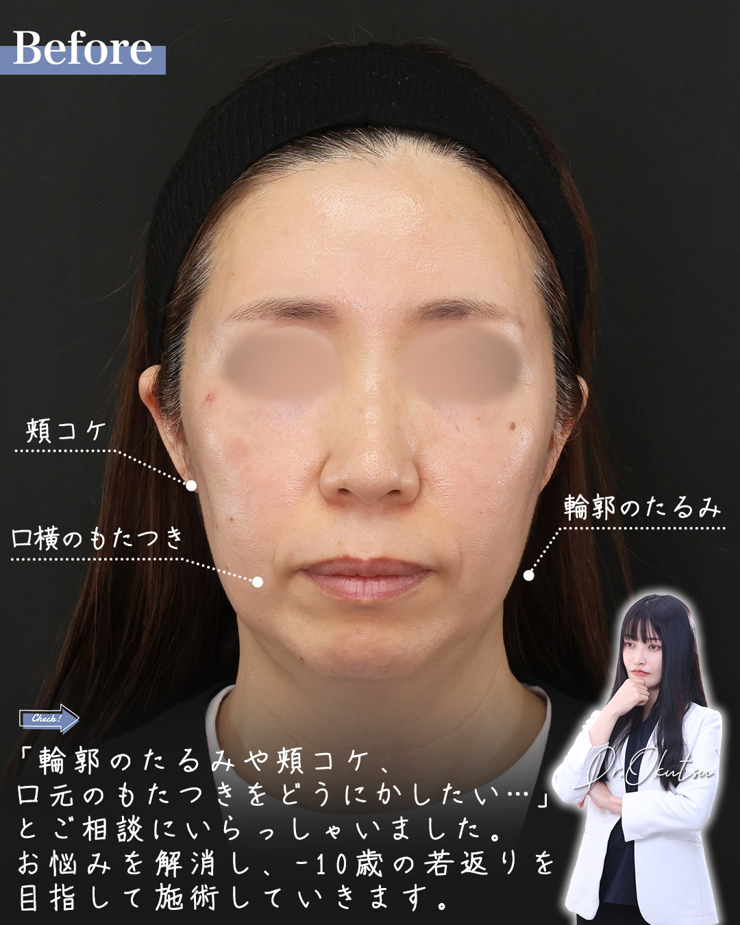 TAC式 ツヤ肌コラーゲンリフト®/TAC式 ショッピングリフト/Lラインファット除去(エラ下脂肪除去)の症例写真 施術前後