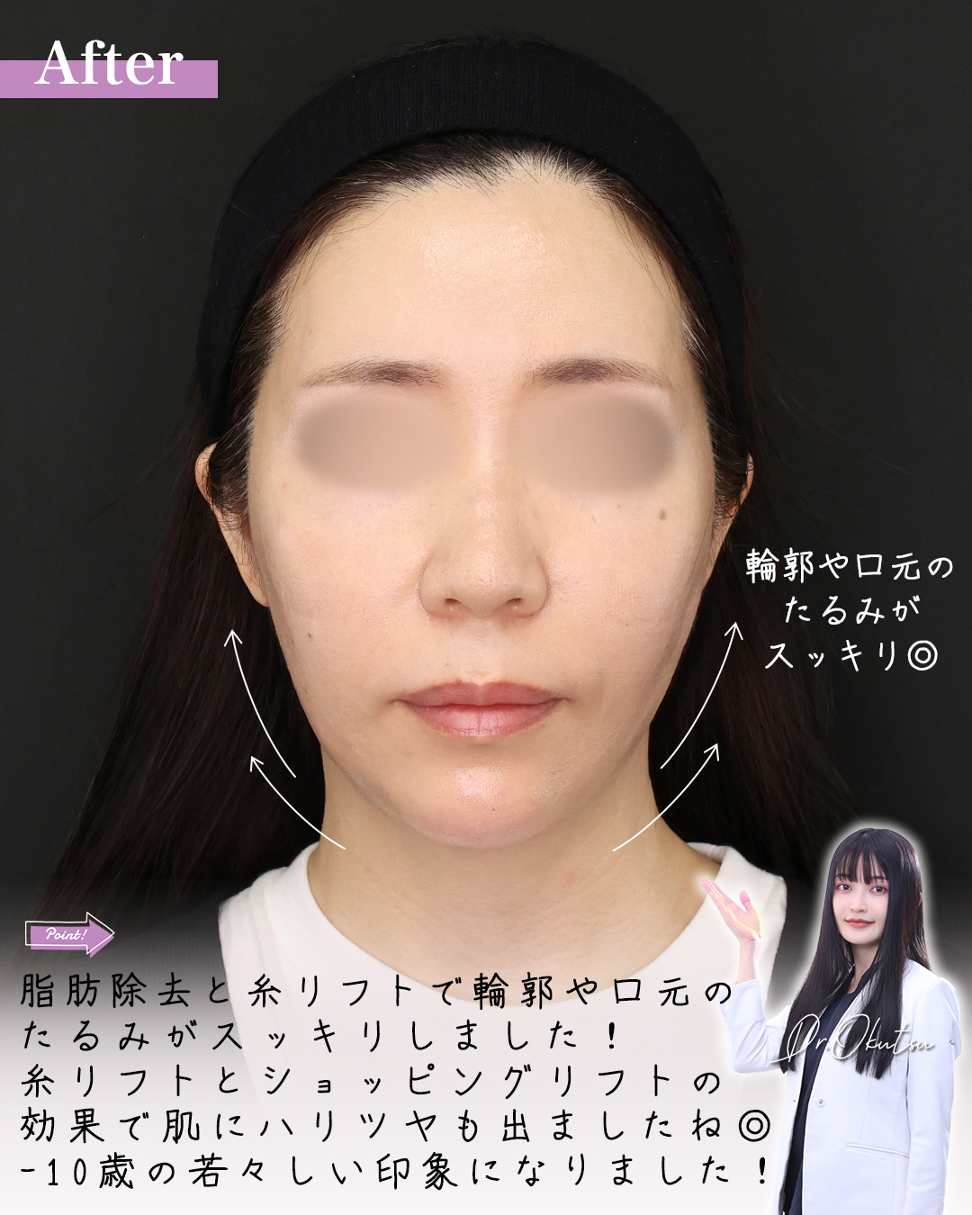 TAC式 ツヤ肌コラーゲンリフト®/TAC式 ショッピングリフト/Lラインファット除去(エラ下脂肪除去)の症例写真 施術前後