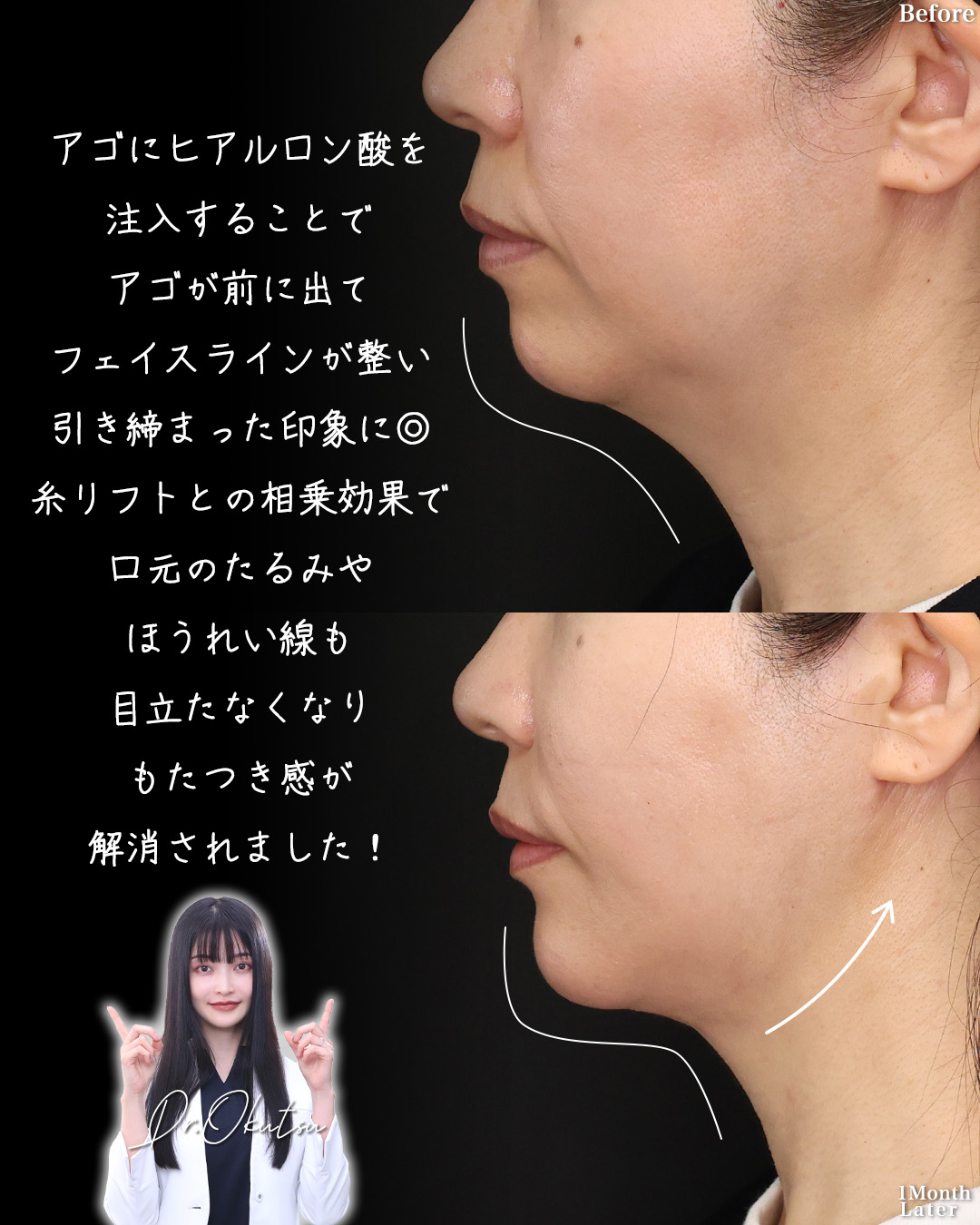 TAC式 ツヤ肌コラーゲンリフト®/TAC式 ショッピングリフト/Lラインファット除去(エラ下脂肪除去)の症例写真 施術前後