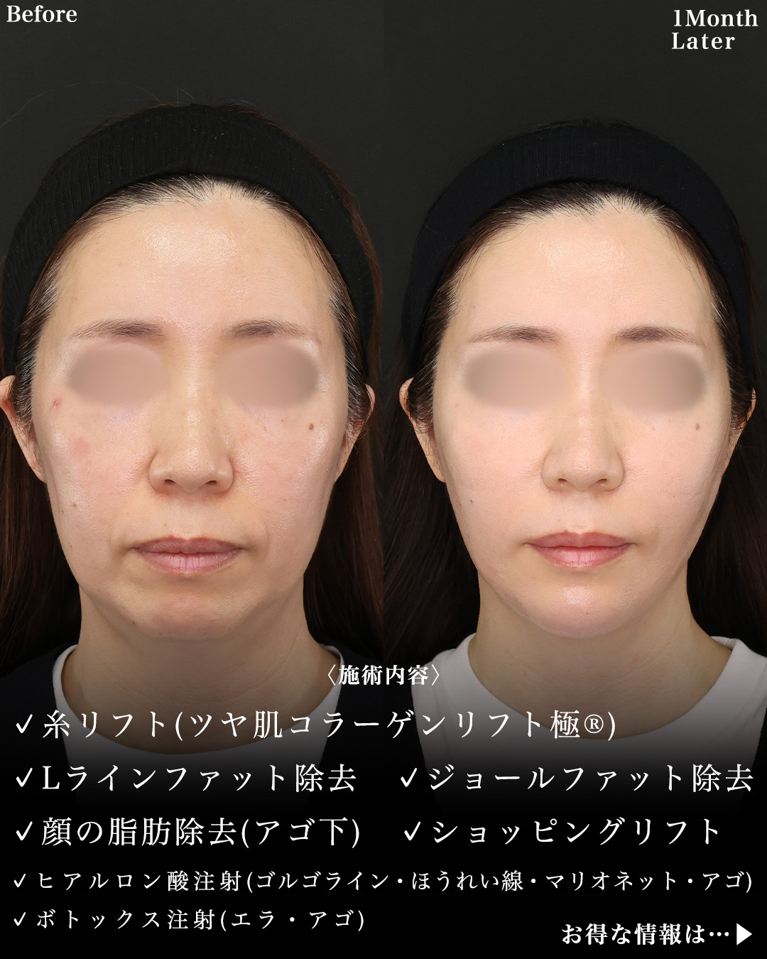 TAC式 ツヤ肌コラーゲンリフト®/TAC式 ショッピングリフト/Lラインファット除去(エラ下脂肪除去)の症例写真 施術前後
