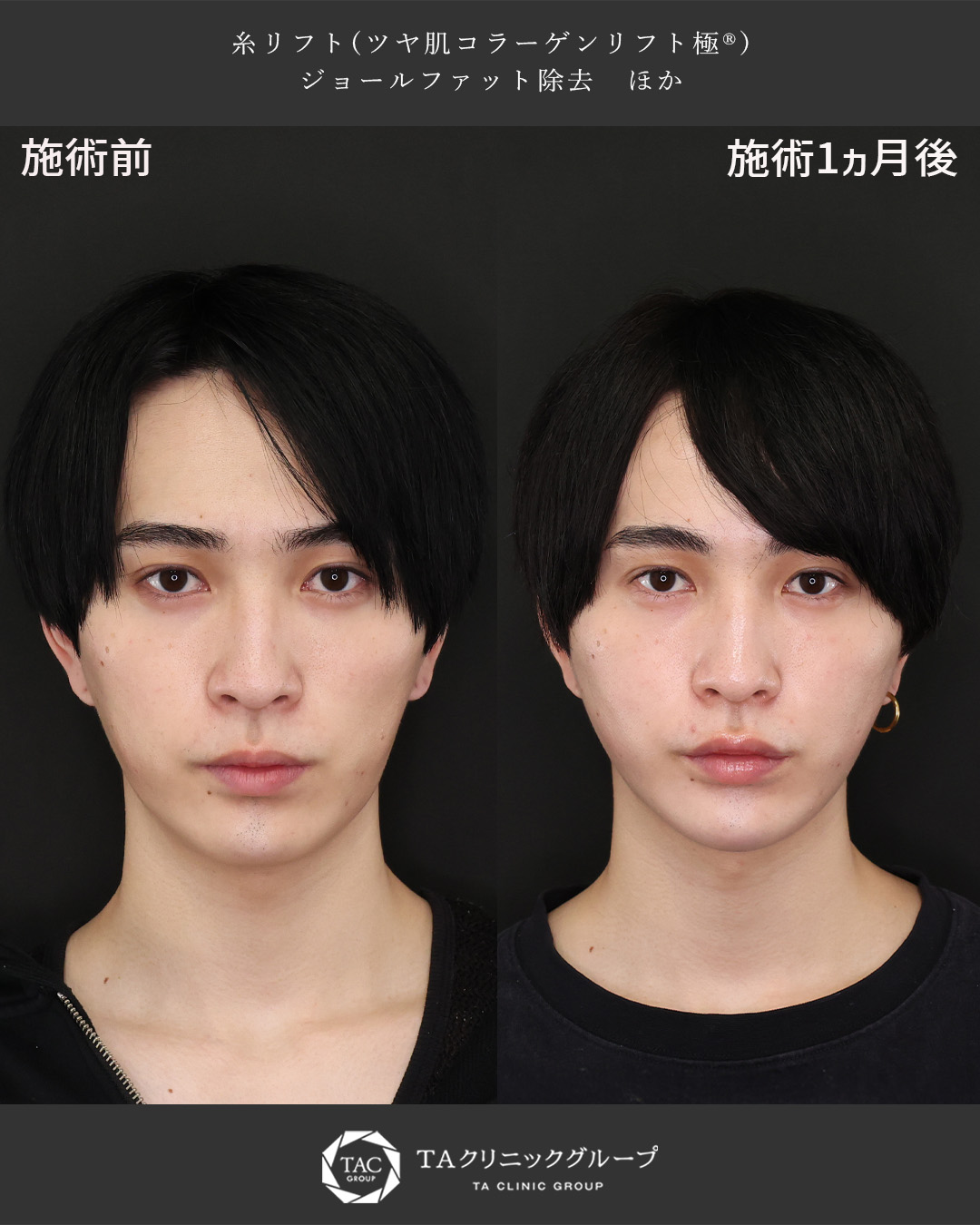 やりすぎ感ゼロでアイドル級の垢抜け顔に｜20代男性の中性的・美形フェイス症例