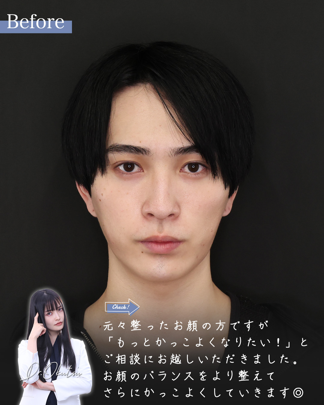 TAC式 ツヤ肌コラーゲンリフト®/ジョールファット除去/おでこ・こめかみのヒアルロン酸注射の症例写真 施術前後 