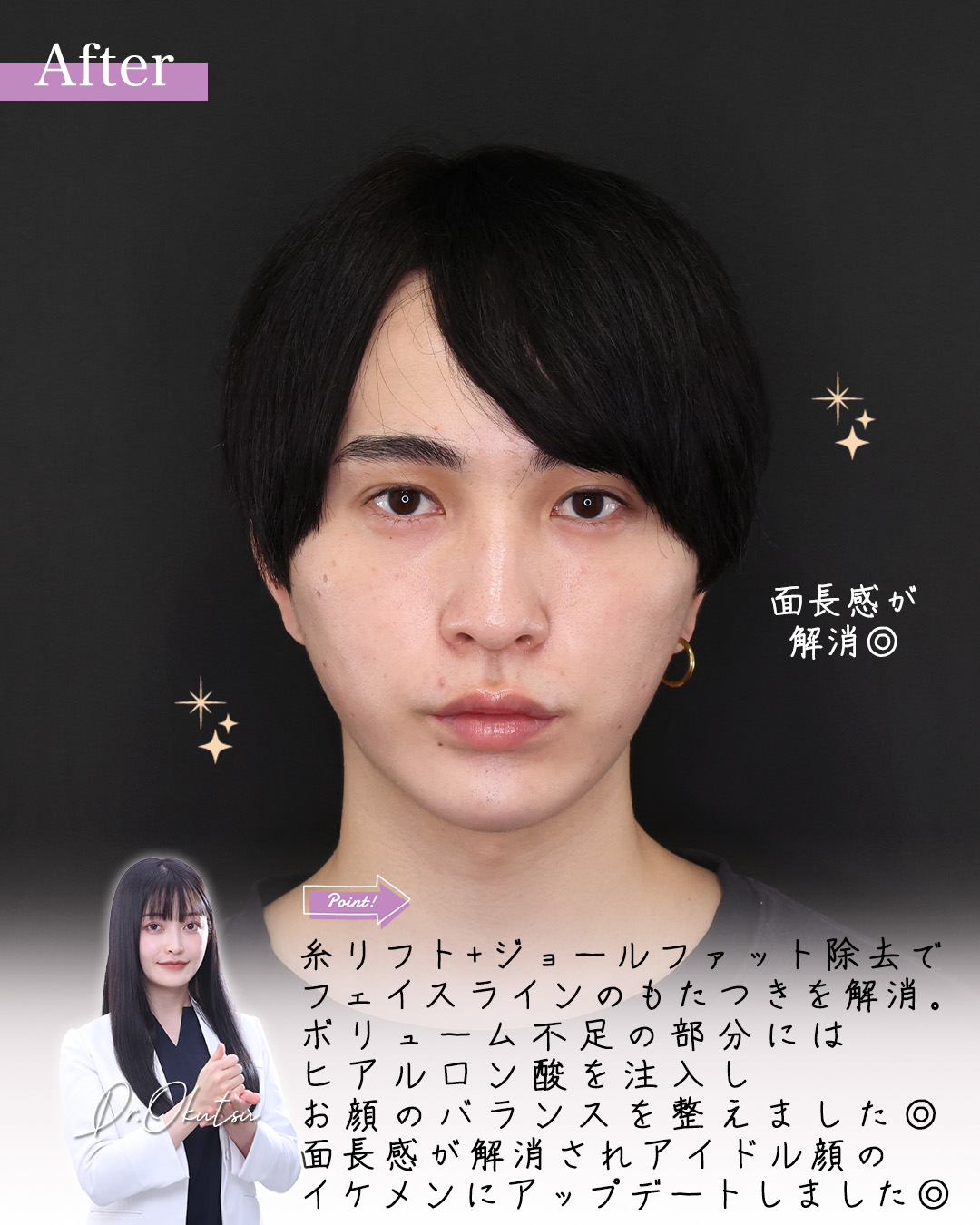 TAC式 ツヤ肌コラーゲンリフト®/ジョールファット除去/おでこ・こめかみのヒアルロン酸注射の症例写真 施術前後 