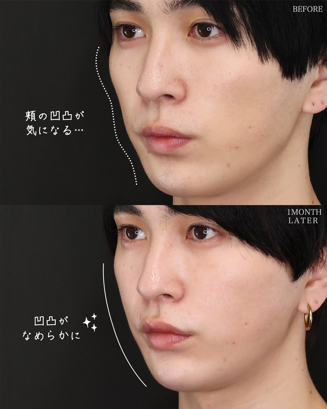 TAC式 ツヤ肌コラーゲンリフト®/ジョールファット除去/おでこ・こめかみのヒアルロン酸注射の症例写真 施術前後 