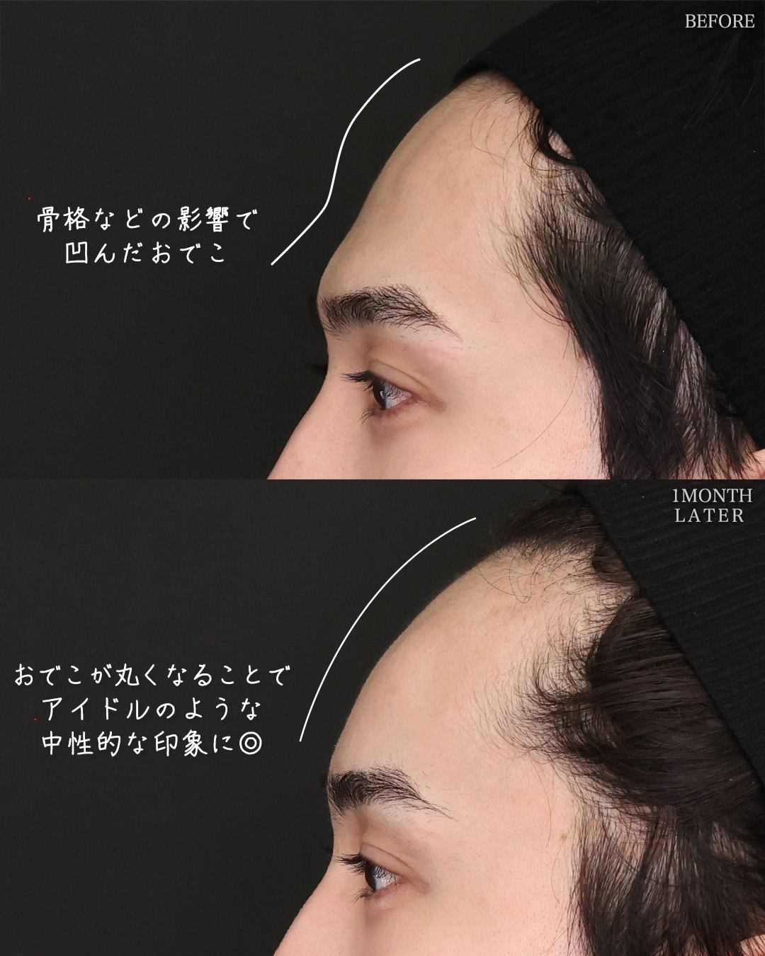 TAC式 ツヤ肌コラーゲンリフト®/ジョールファット除去/おでこ・こめかみのヒアルロン酸注射の症例写真 施術前後 