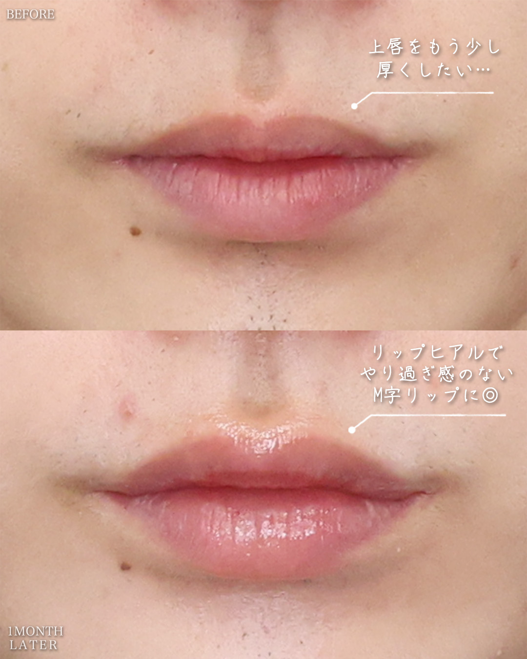 TAC式 ツヤ肌コラーゲンリフト®/ジョールファット除去/おでこ・こめかみのヒアルロン酸注射の症例写真 施術前後 