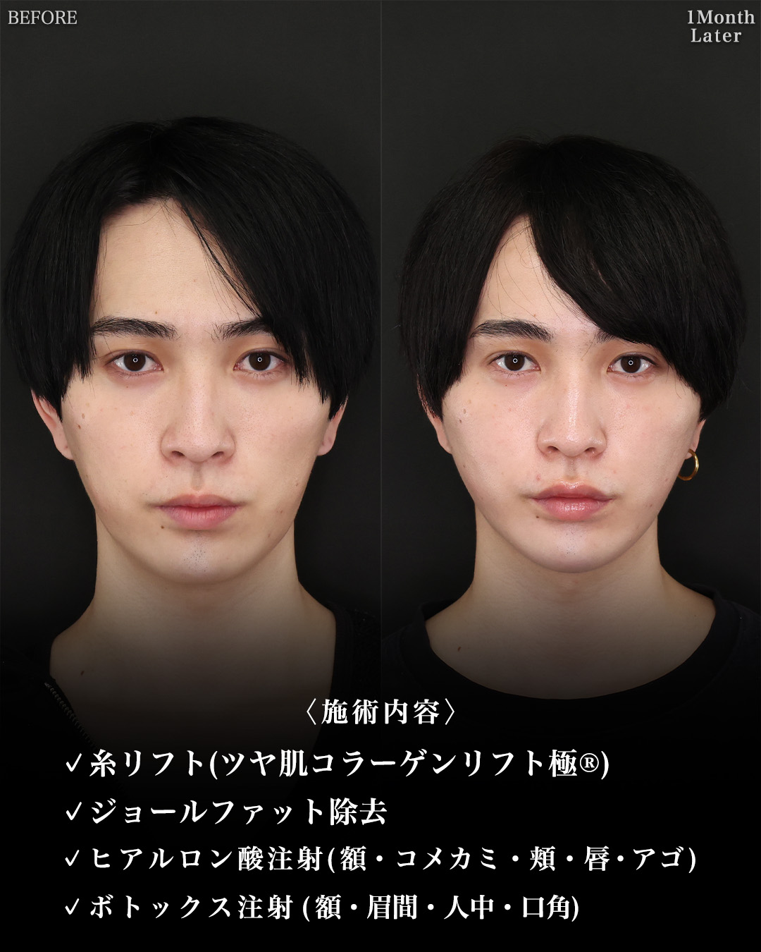 TAC式 ツヤ肌コラーゲンリフト®/ジョールファット除去/おでこ・こめかみのヒアルロン酸注射の症例写真 施術前後 