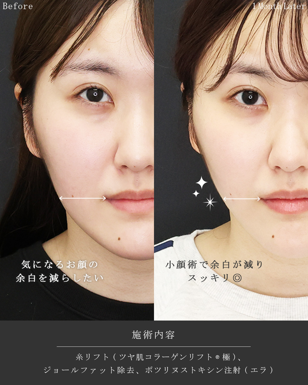 TAC式 ツヤ肌コラーゲンリフト®/ジョールファット除去の症例写真 施術前後 