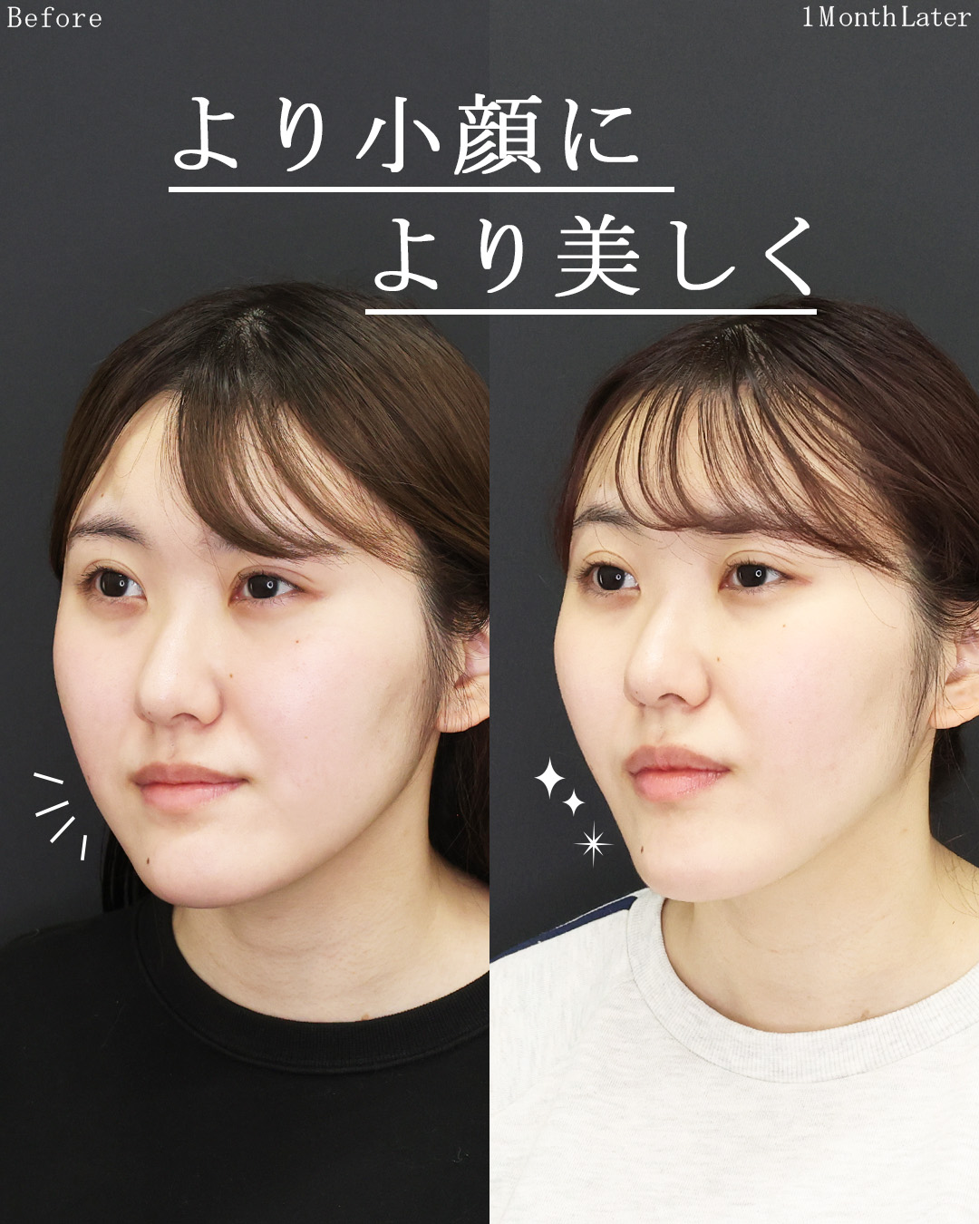 TAC式 ツヤ肌コラーゲンリフト®/ジョールファット除去の症例写真 施術前後 