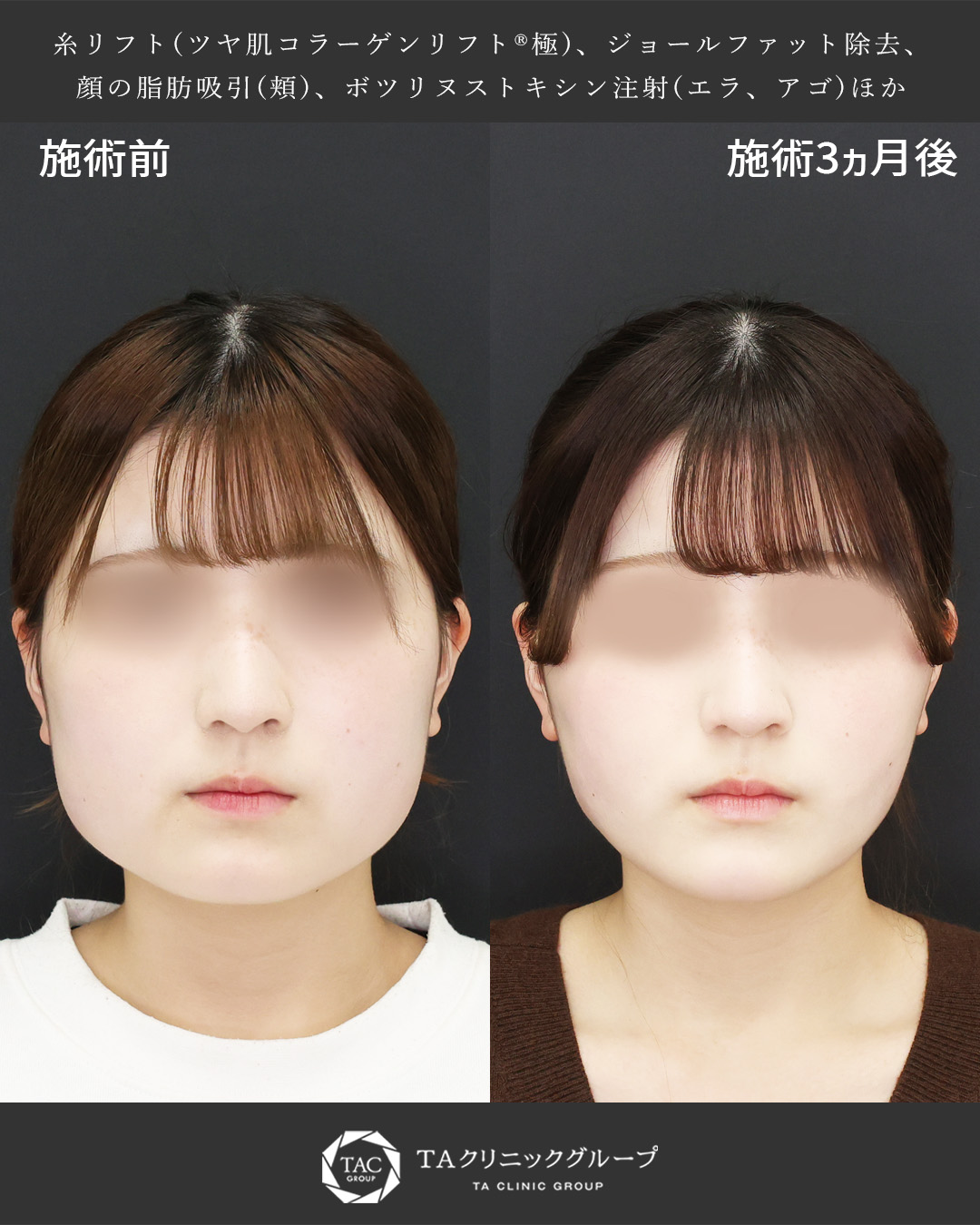 【別人級小顔術】四角に見える輪郭を整える