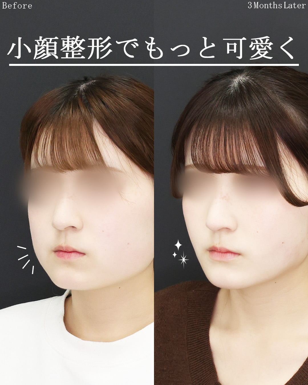 TAC式 ツヤ肌コラーゲンリフト®/ジョールファット除去/顔の脂肪吸引の症例写真 施術前後 