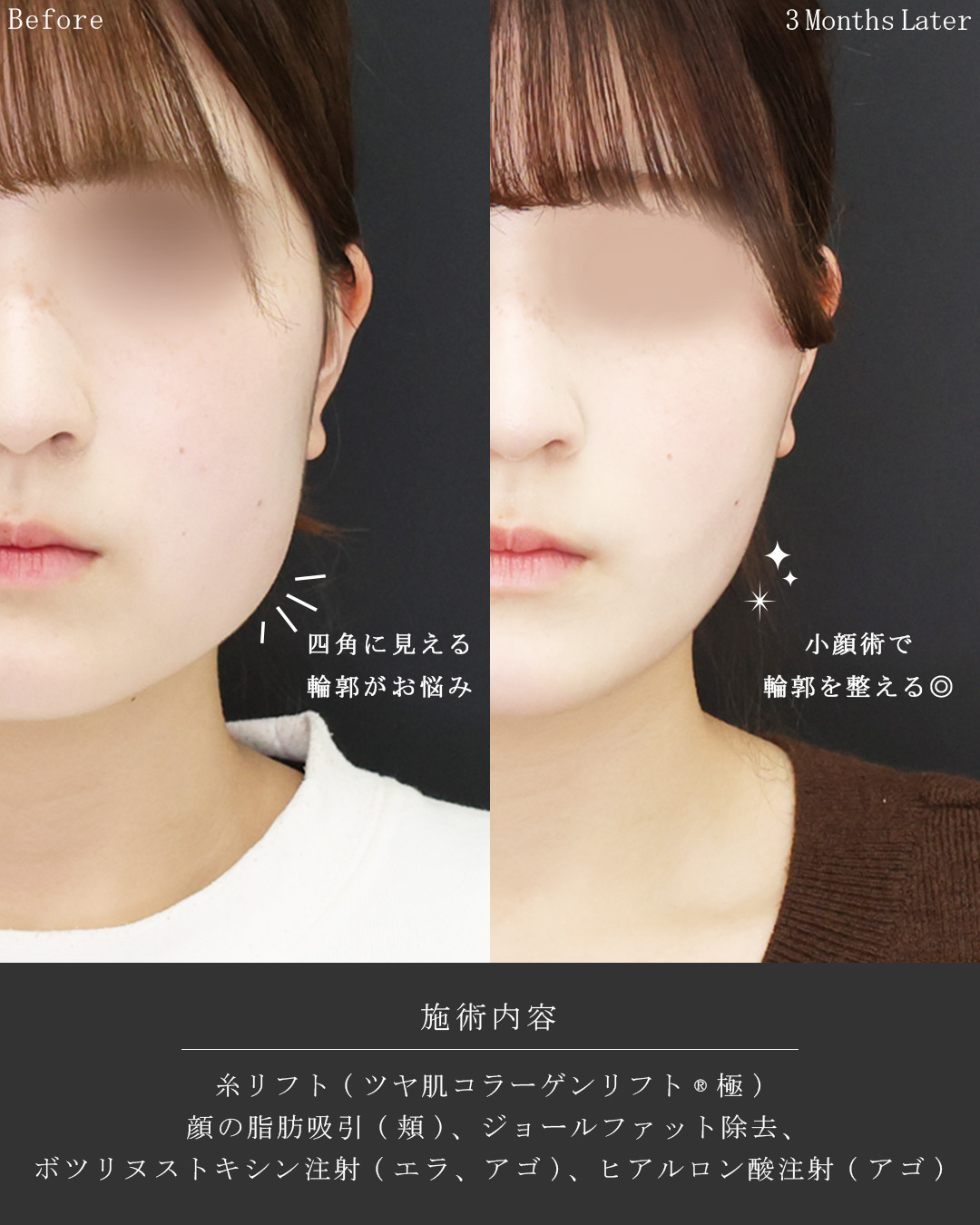 TAC式 ツヤ肌コラーゲンリフト®/ジョールファット除去/顔の脂肪吸引の症例写真 施術前後 