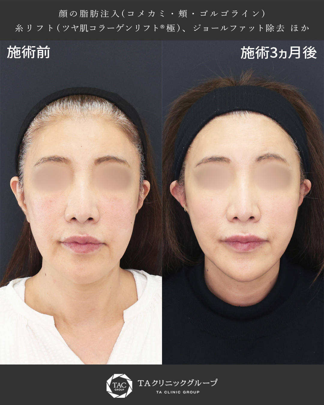 【60代女性】ボリュームケア美容|老け見えの原因改善