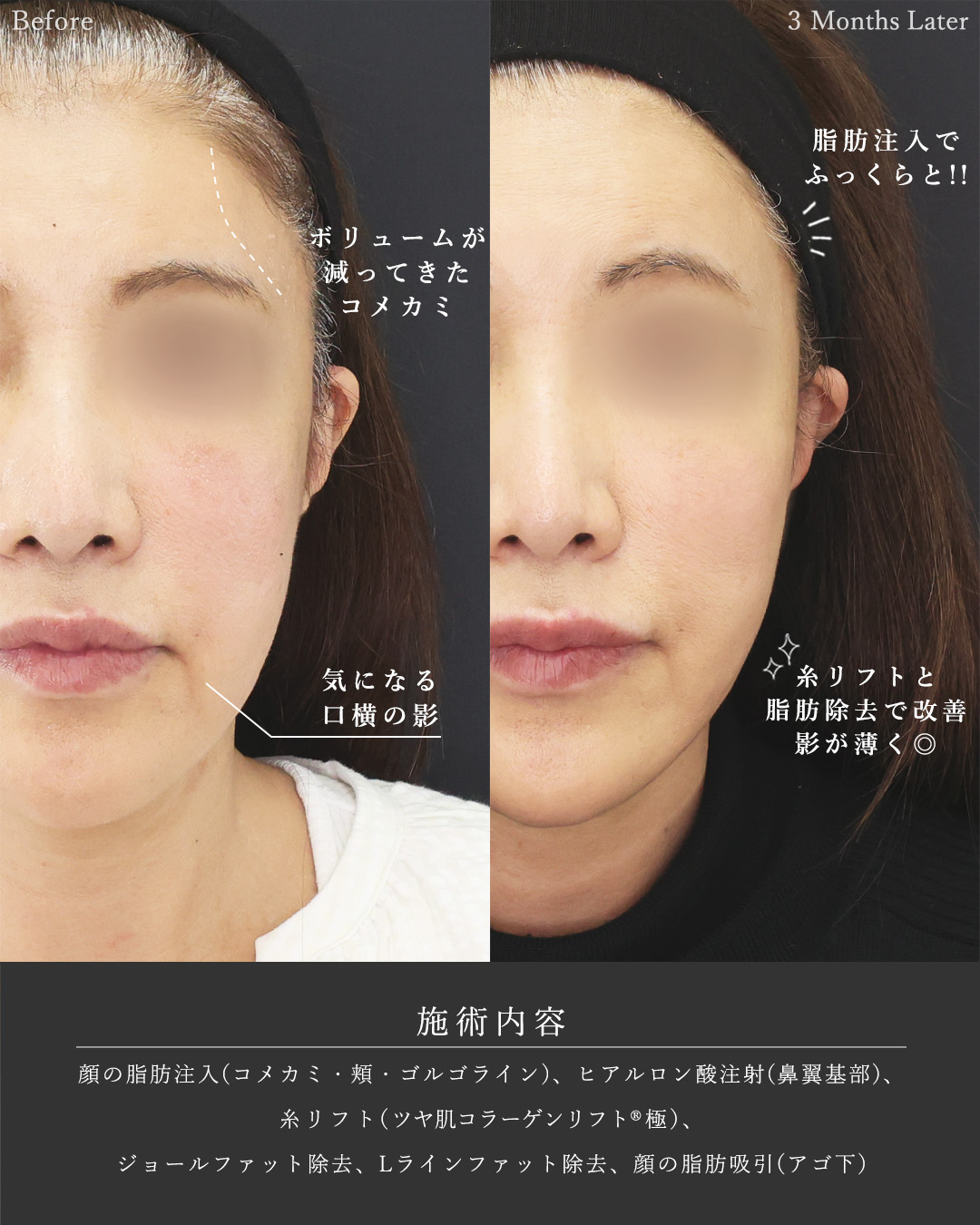 顔の脂肪注入(コンデンスリッチフェイス)/TAC式 ツヤ肌コラーゲンリフト®/顎下の脂肪吸引の症例写真 施術前後 