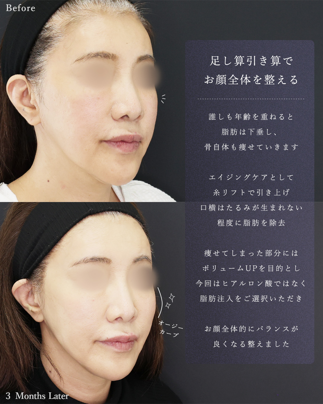 顔の脂肪注入(コンデンスリッチフェイス)/TAC式 ツヤ肌コラーゲンリフト®/顎下の脂肪吸引の症例写真 施術前後 