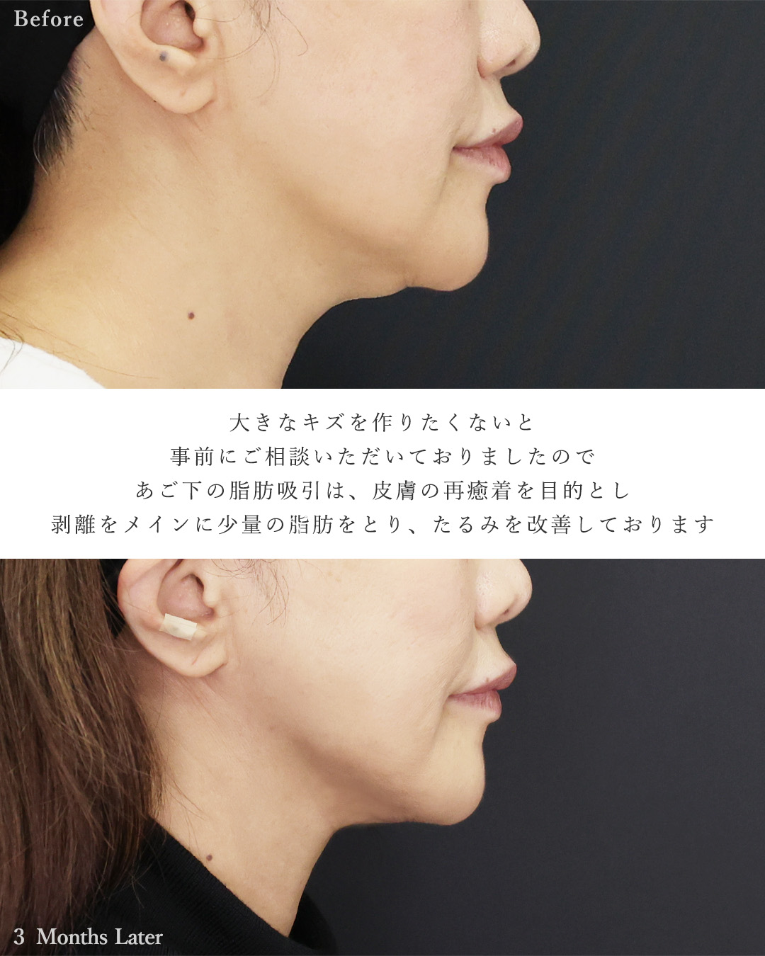 顔の脂肪注入(コンデンスリッチフェイス)/TAC式 ツヤ肌コラーゲンリフト®/顎下の脂肪吸引の症例写真 施術前後 