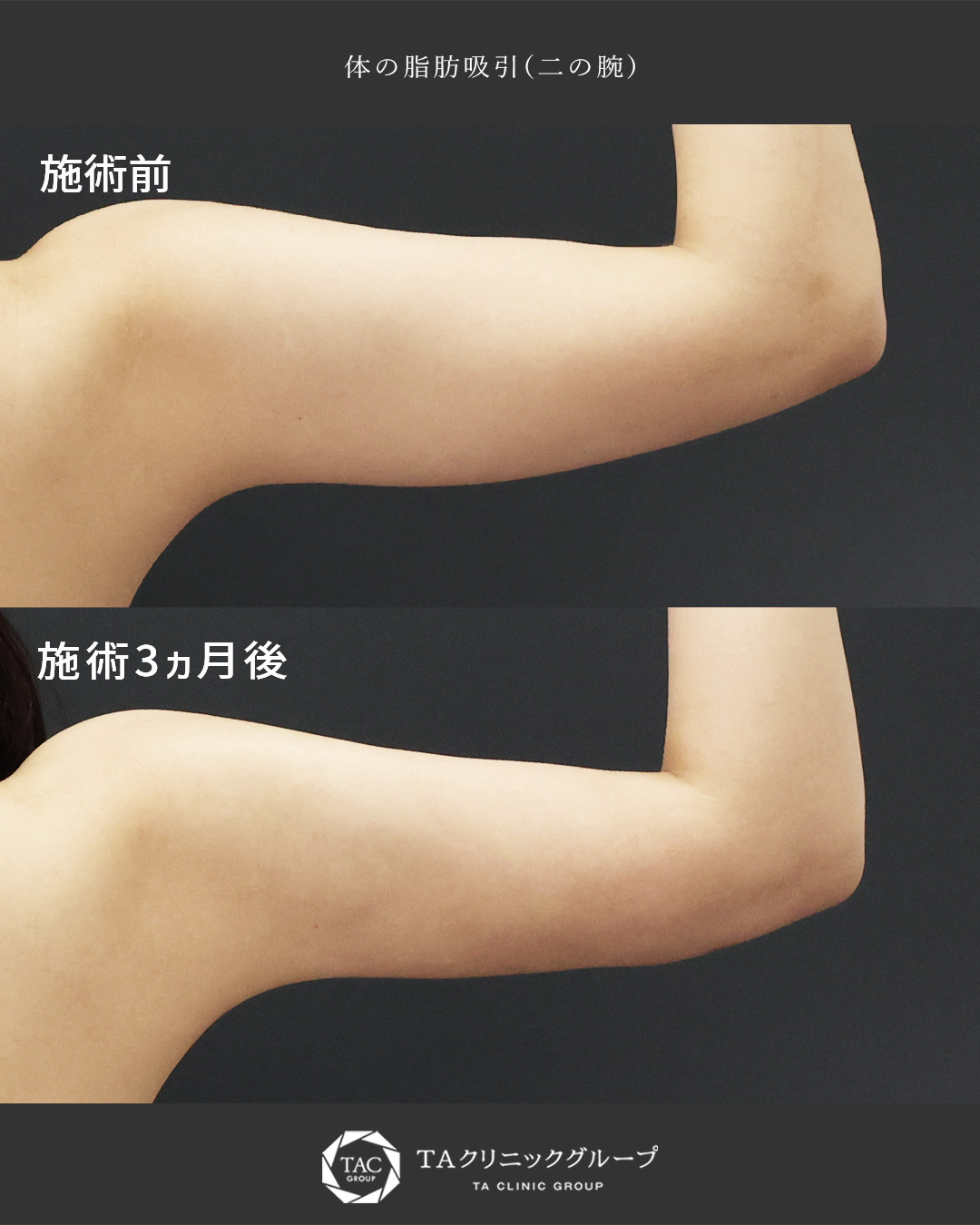 振り袖改善｜夏に自信の持てる二の腕に！【二の腕の脂肪吸引】