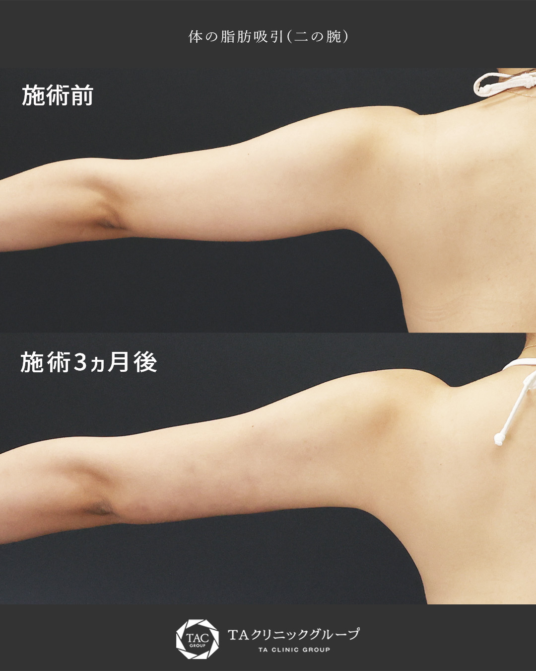 体の脂肪吸引の症例写真 施術前後 