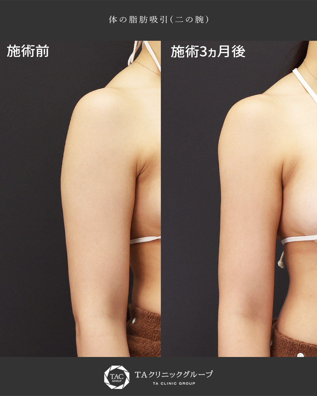 体の脂肪吸引の症例写真 施術前後 