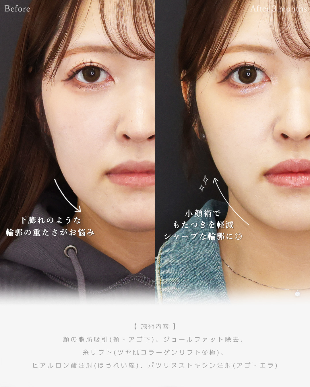 顔の脂肪吸引/ジョールファット除去/TAC式 ツヤ肌コラーゲンリフト®の症例写真 施術前後 