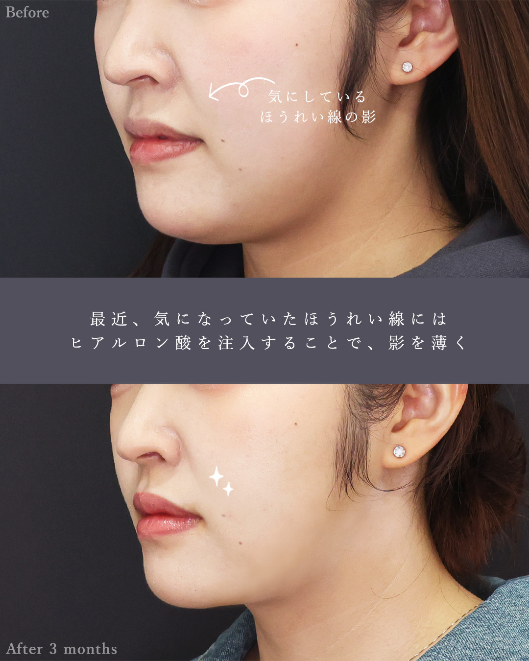 顔の脂肪吸引/ジョールファット除去/TAC式 ツヤ肌コラーゲンリフト®の症例写真 施術前後 