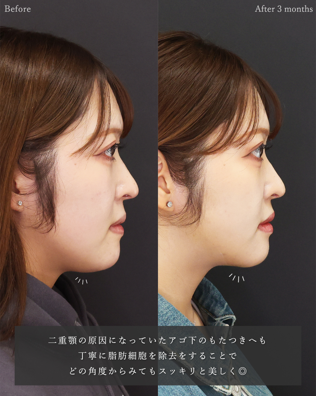 顔の脂肪吸引/ジョールファット除去/TAC式 ツヤ肌コラーゲンリフト®の症例写真 施術前後 