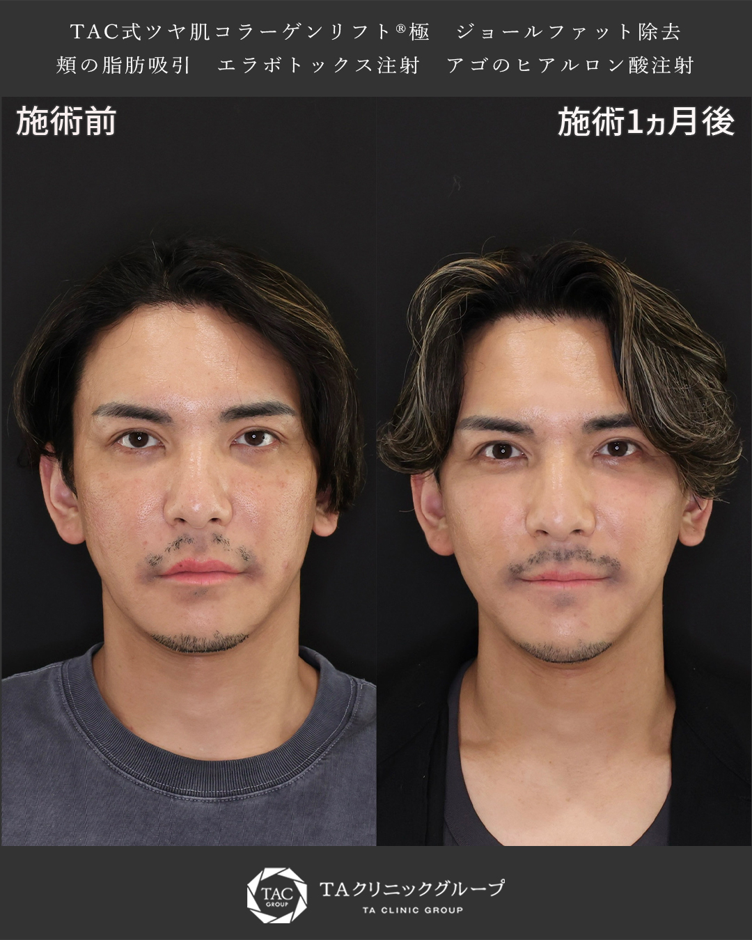 TAC式 ツヤ肌コラーゲンリフト®/ジョールファット除去/顔の脂肪吸引の症例写真 施術前後