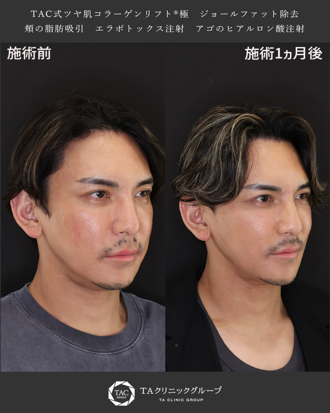 TAC式 ツヤ肌コラーゲンリフト®/ジョールファット除去/顔の脂肪吸引の症例写真 施術前後