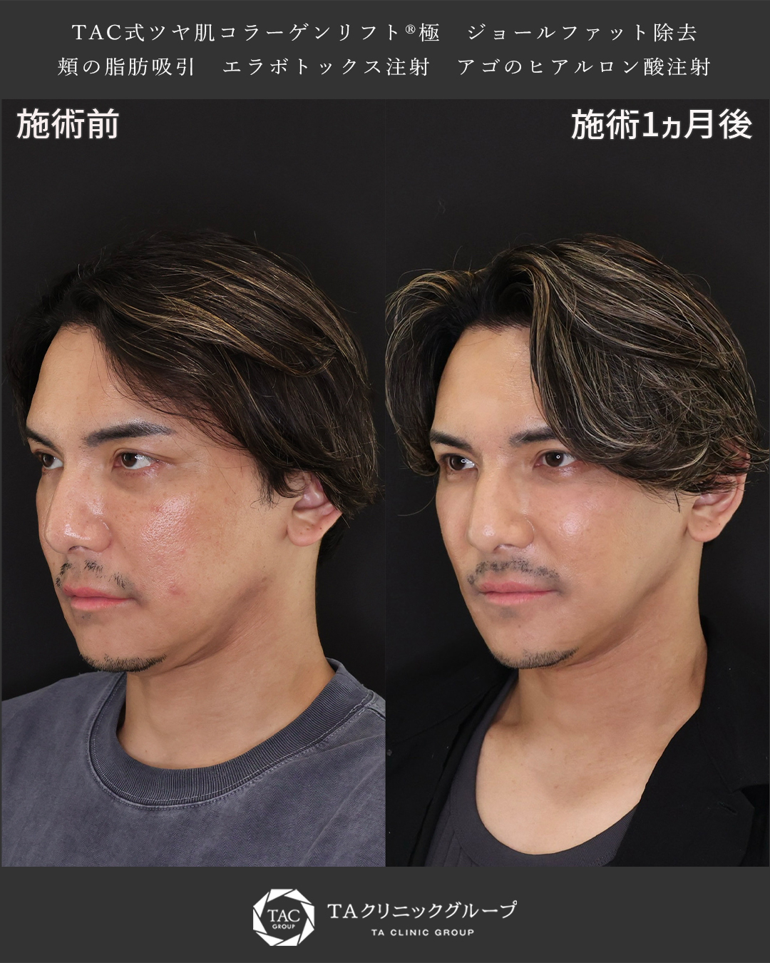 TAC式 ツヤ肌コラーゲンリフト®/ジョールファット除去/顔の脂肪吸引の症例写真 施術前後