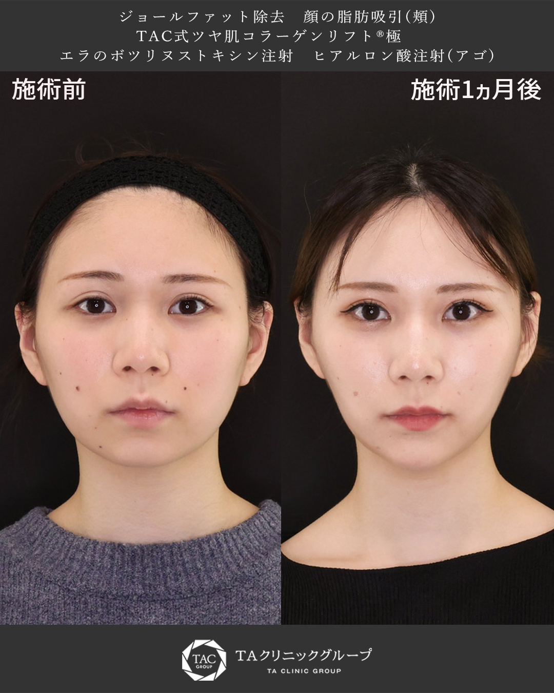 【小顔脂肪吸引】求心顔から韓国アイドルのような綺麗な卵型フェイスラインに