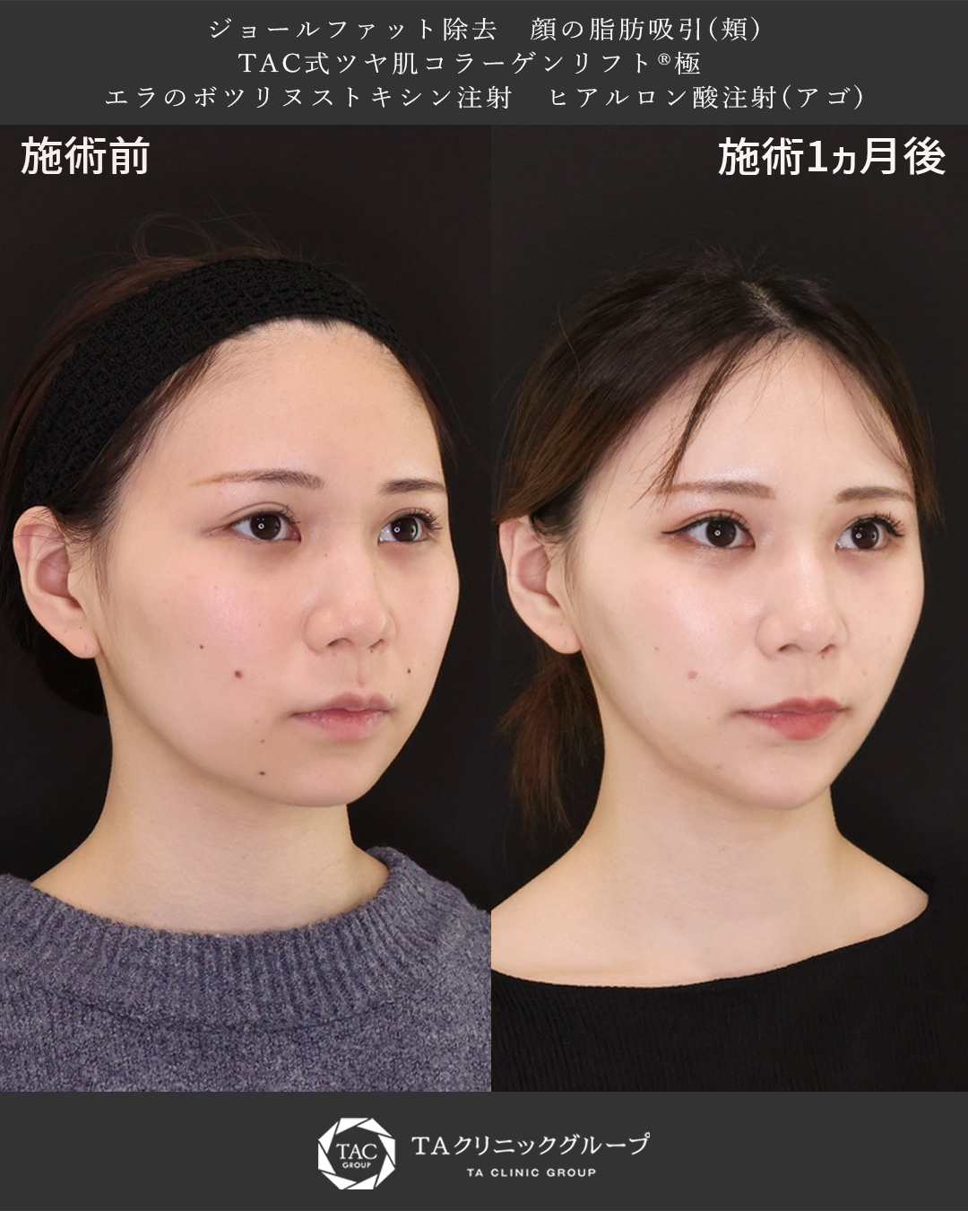 TAC式 ツヤ肌コラーゲンリフト®/ジョールファット除去/顔の脂肪吸引の症例写真 施術前後 