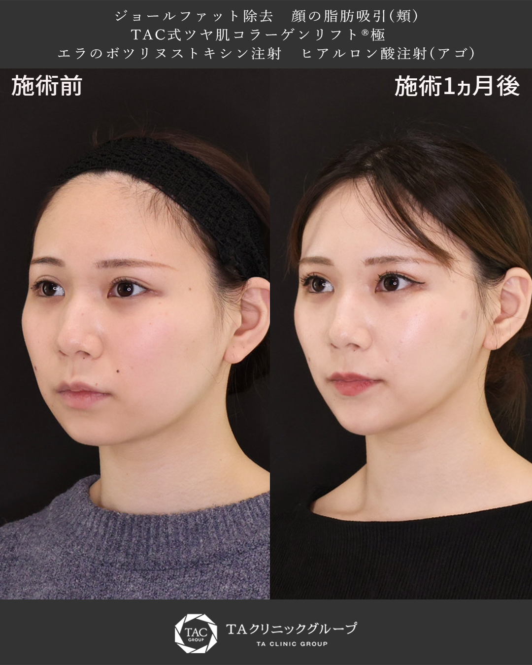 TAC式 ツヤ肌コラーゲンリフト®/ジョールファット除去/顔の脂肪吸引の症例写真 施術前後 