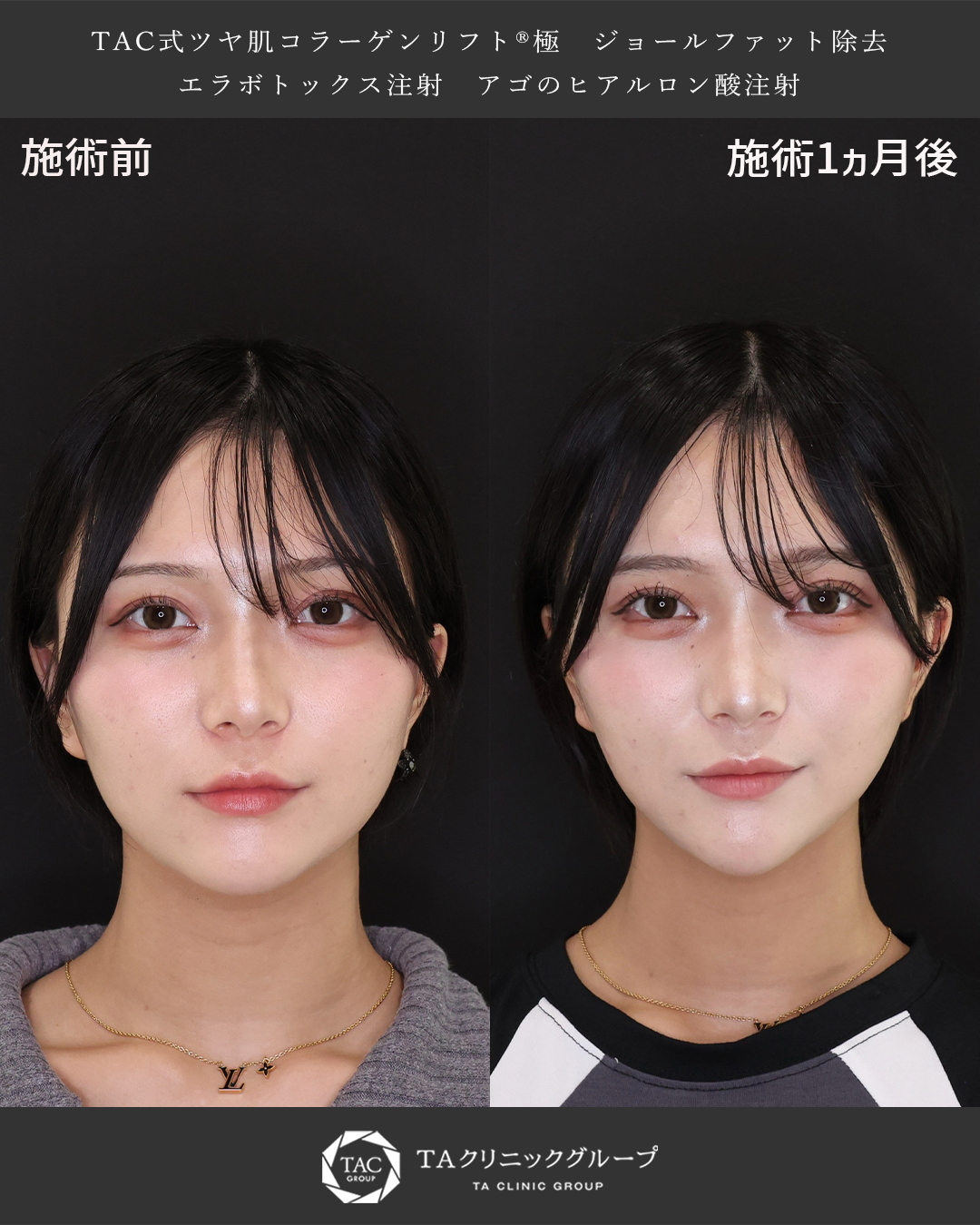 【Dr.森】顔の余白を減らして韓国アイドルのような美しい卵型フェイスラインに【小顔脂肪吸引】