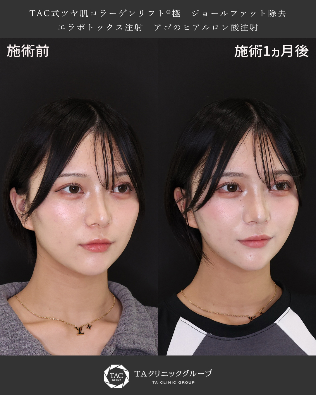 TAC式 ツヤ肌コラーゲンリフト®/ジョールファット除去/顎のヒアルロン酸注射の症例写真 施術前後 