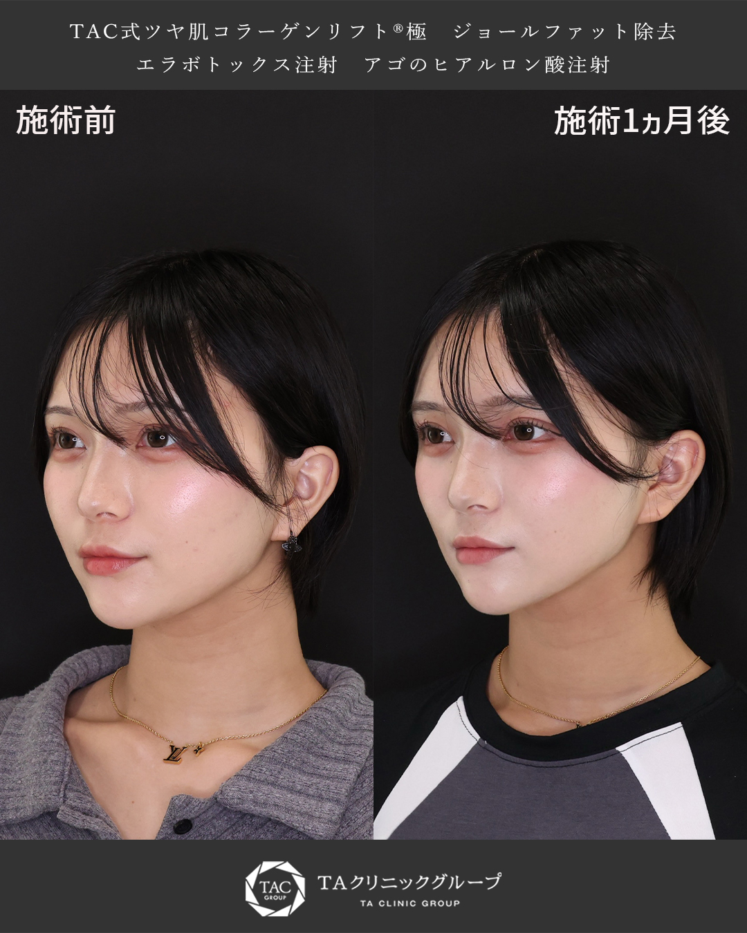 TAC式 ツヤ肌コラーゲンリフト®/ジョールファット除去/顎のヒアルロン酸注射の症例写真 施術前後 