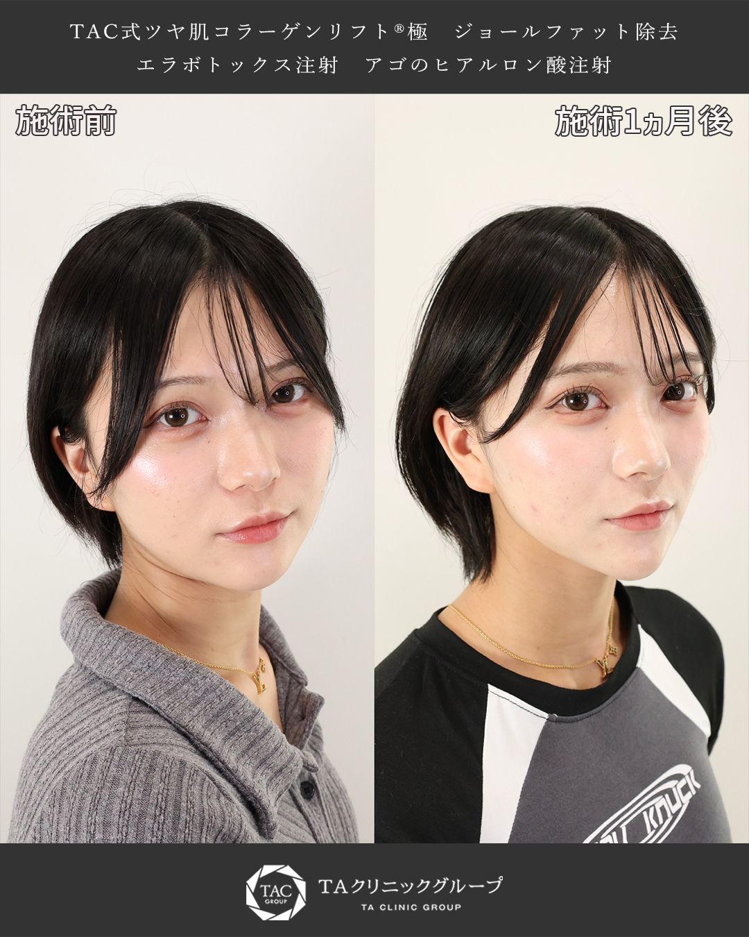 TAC式 ツヤ肌コラーゲンリフト®/ジョールファット除去/顎のヒアルロン酸注射の症例写真 施術前後 