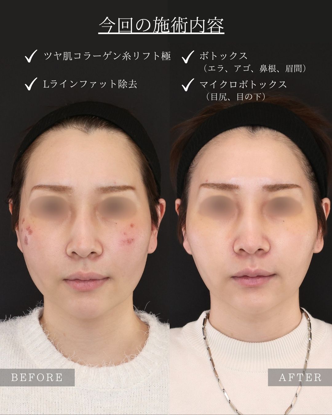 TAC式 ツヤ肌コラーゲンリフト®/Lラインファット除去(エラ下脂肪除去)/ボトックス注射:その他の症例写真 施術前後