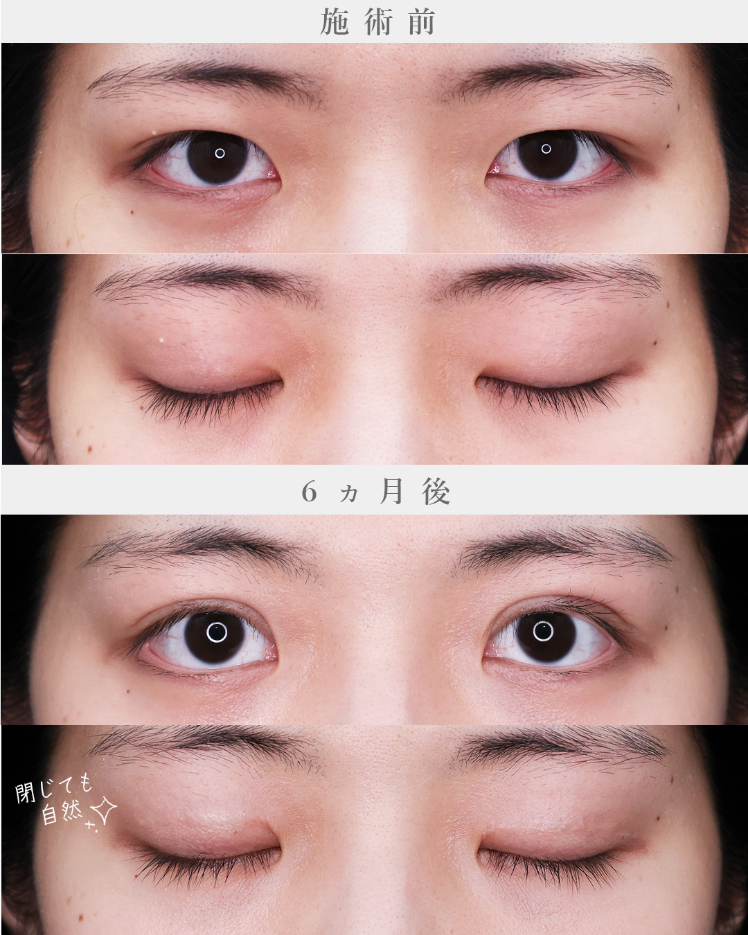 上眼瞼切開術の症例写真 施術前後 