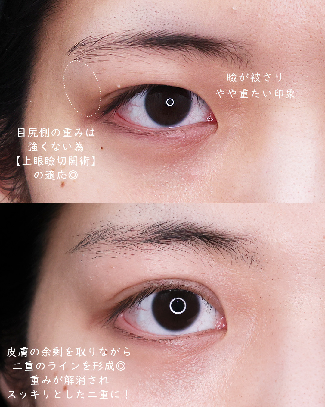 上眼瞼切開術の症例写真 施術前後 