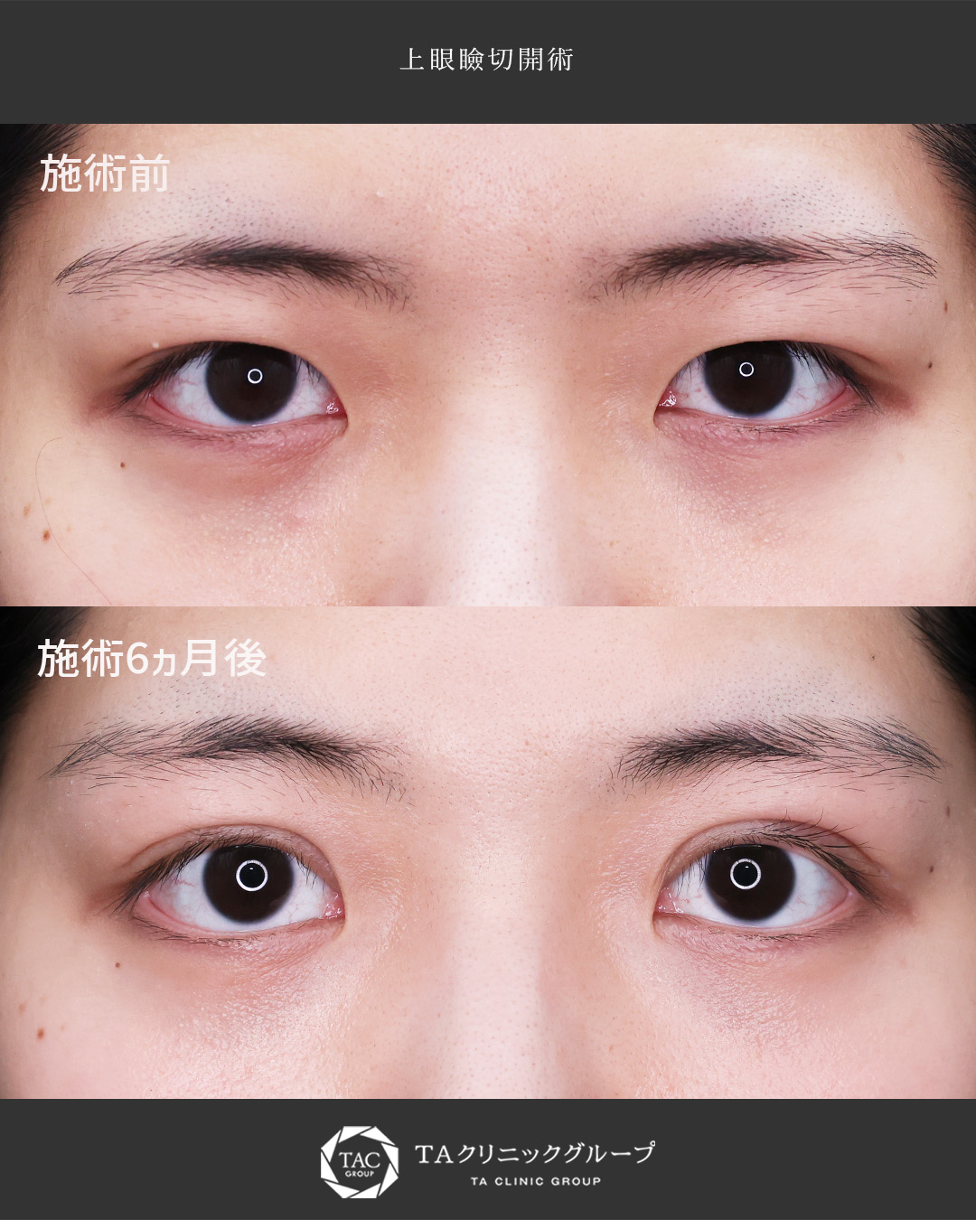 【たるみ除去×二重形成】スッキリ幅広の二重に