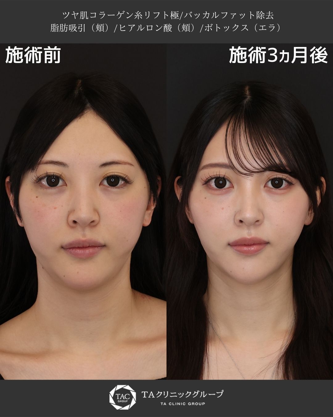 他院脂肪吸引後のボコつきを修正　自然で美しい輪郭へ