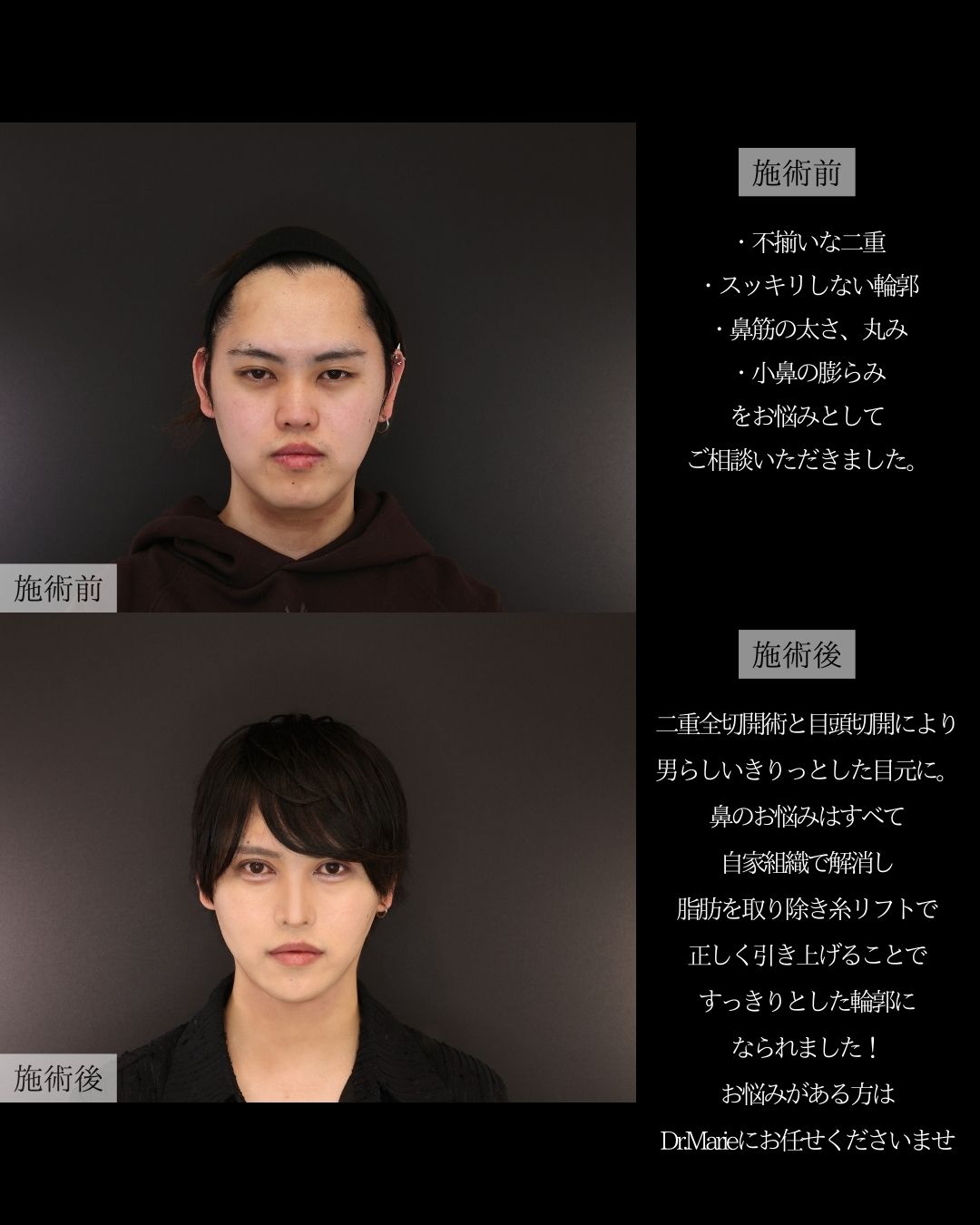 二重切開（全切開法）/目頭切開術/TAC式 ツヤ肌コラーゲンリフト®の症例写真 施術前後 