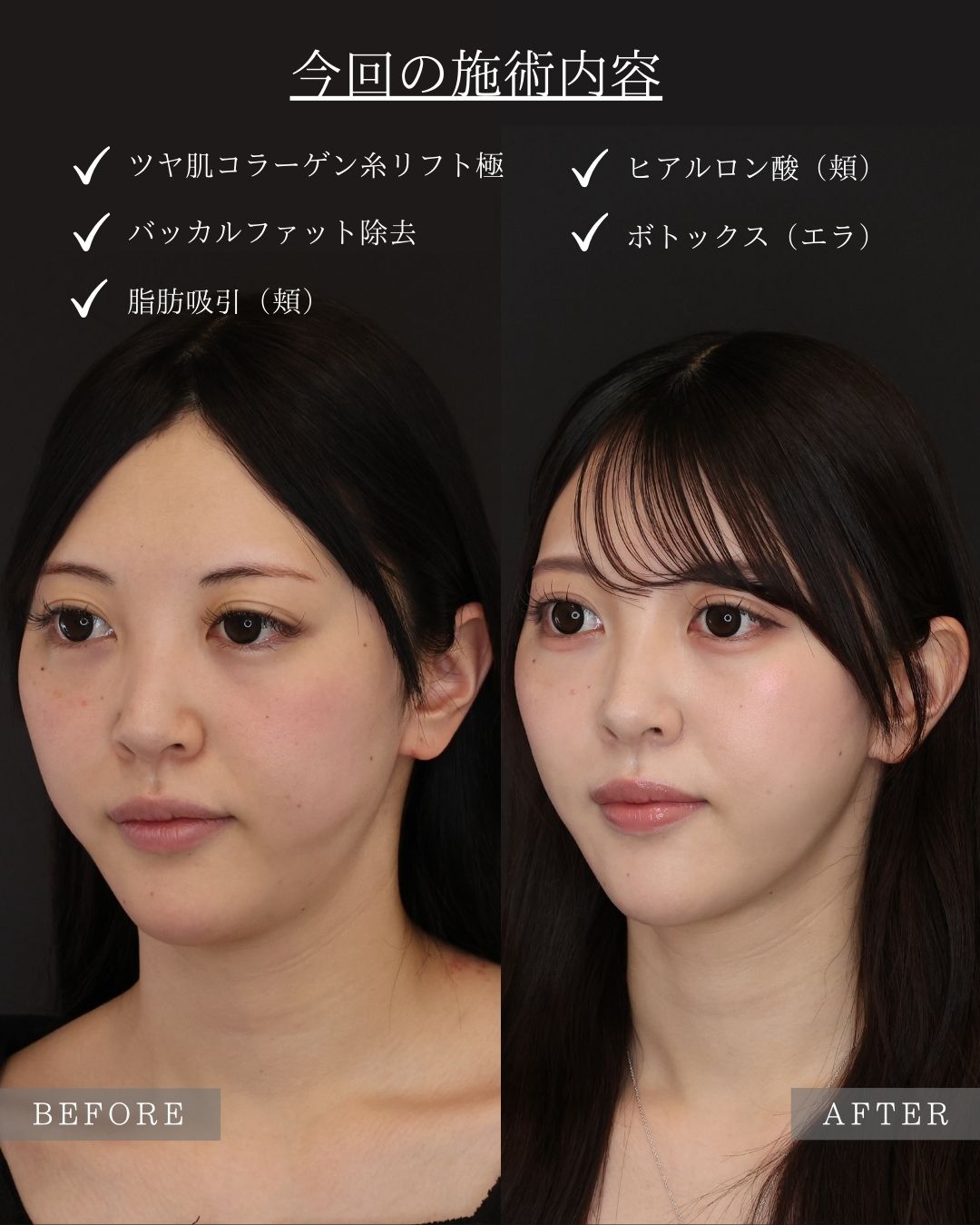 TAC式 ツヤ肌コラーゲンリフト®/バッカルファット除去/顔の脂肪吸引の症例写真 施術前後 