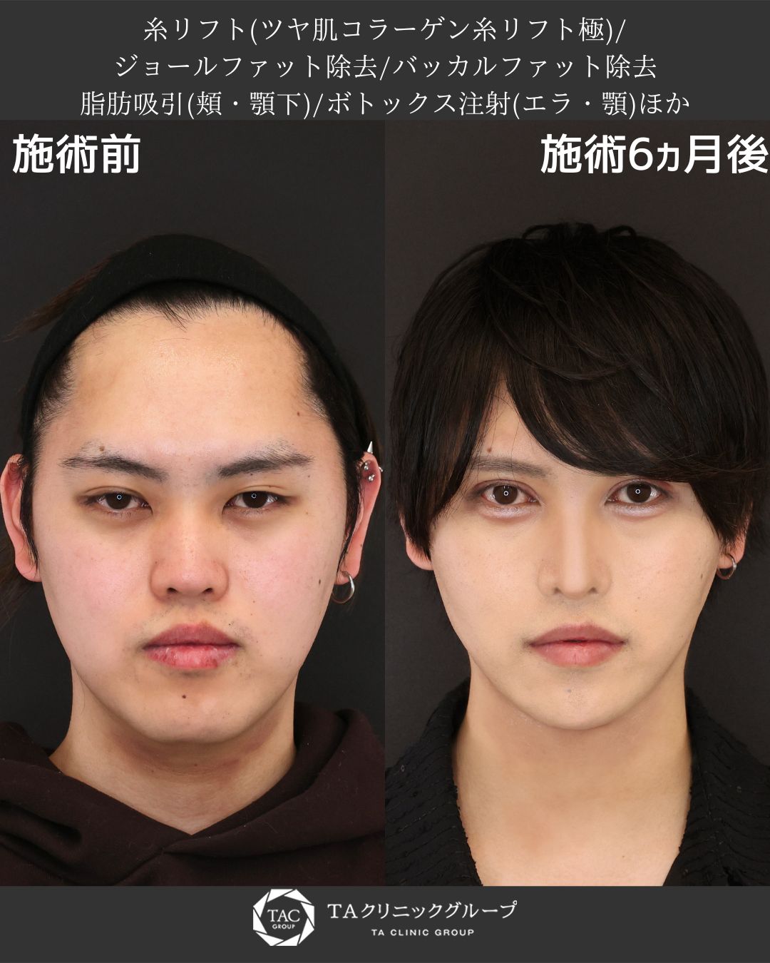 糸リフト×脂肪除去で理想の小顔ラインに