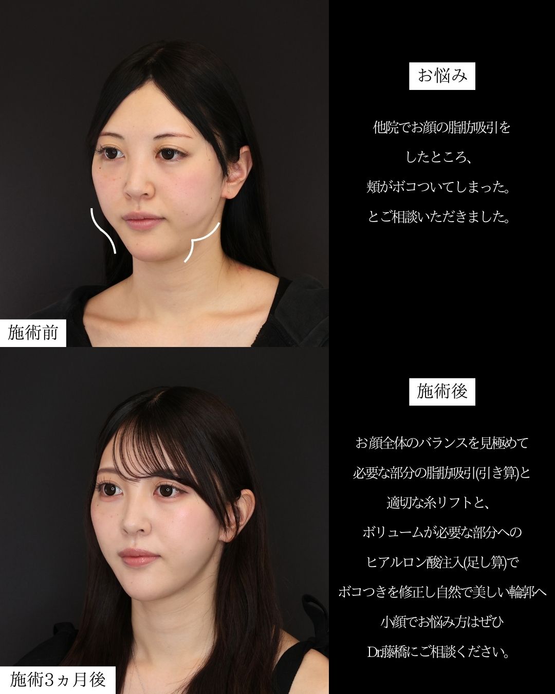 TAC式 ツヤ肌コラーゲンリフト®/バッカルファット除去/顔の脂肪吸引の症例写真 施術前後 