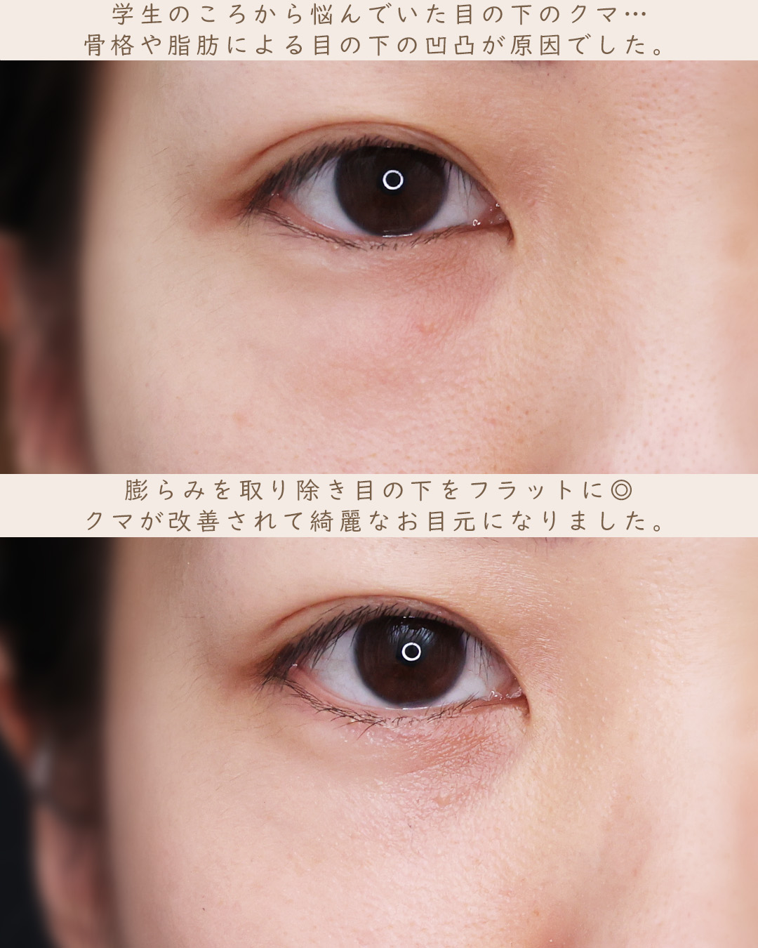 下眼瞼脱脂術（目の下のたるみ取り・目の下の脂肪ふくらみ取り）の症例写真 施術前後 