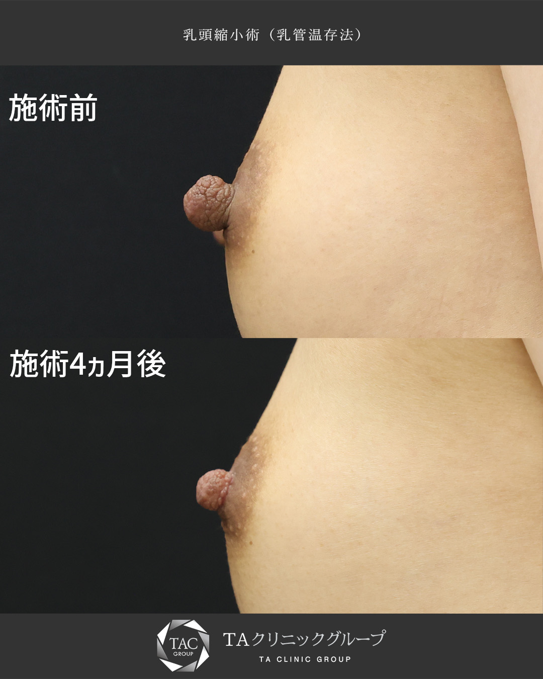 【乳頭縮小】授乳後の乳頭を綺麗に整える